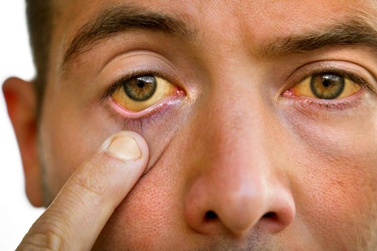 تشخیص علائم هپاتیت از روی چهره